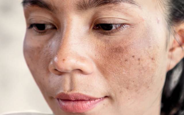 How Does Sun Exposure Influence Melasma Treatment?