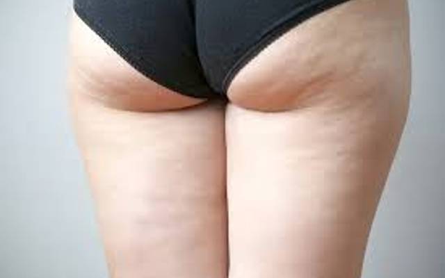 How Does Medical Cellulite Treatment Improve Skin?