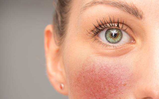 What Is The Goal Of Professional Rosacea Treatment?