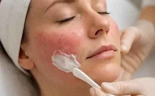 What Rosacea Treatment Focuses On Beneath the Surface