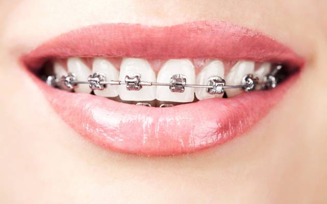 What Is Teeth Straightening and Alignment Process?