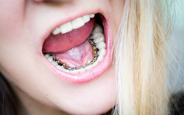 What Are Invisible Lingual Braces Made Of?