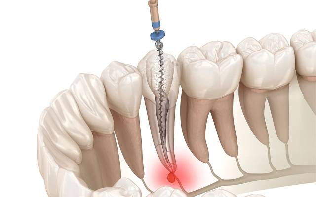 What Are the Signs of a Root Canal Infection?