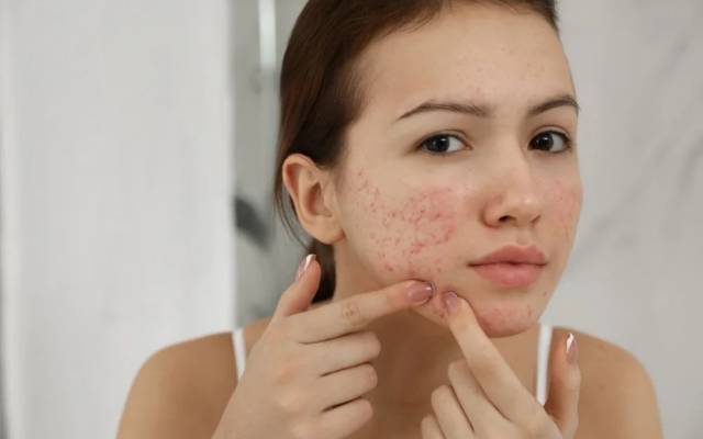 What is the Medical Definition of Pimples Treatment?