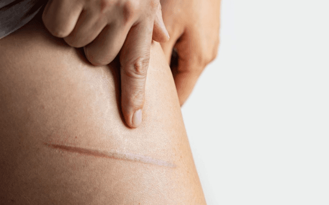 Is Surgical Scar Revision Appropriate for Hypertrophic Scars?