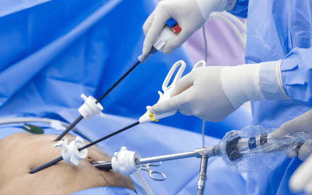 What Determines the Need for Gallbladder Stones Surgery?