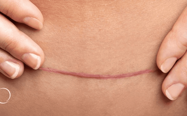 Is Surgical Scar Revision Appropriate for Hypertrophic Tissue?