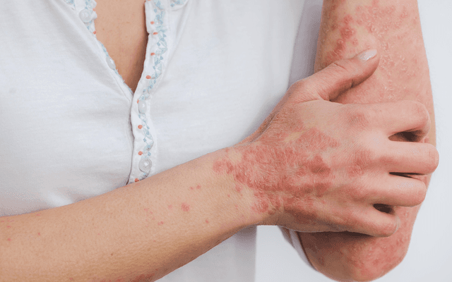 Who Avoids Skin Diseases Treatment?