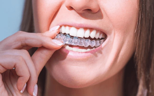 How Aligners Improve Smile Appearance Fast?
