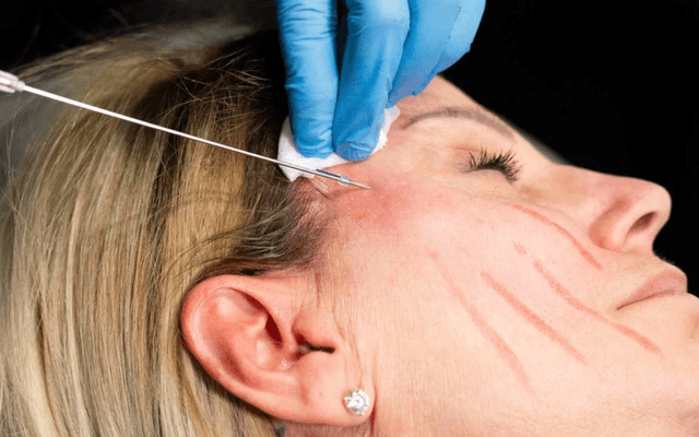 Who Offers Budget-Friendly Thread Lift Cost?