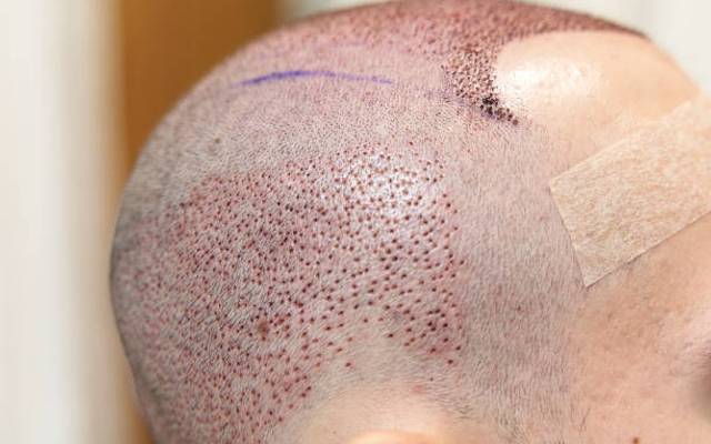 Non-Surgical Prep for Hair Transplant: Maximizing Your Chances