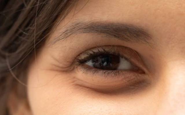 Eye Bag Removal: What Causes Under-Eye Puffiness?