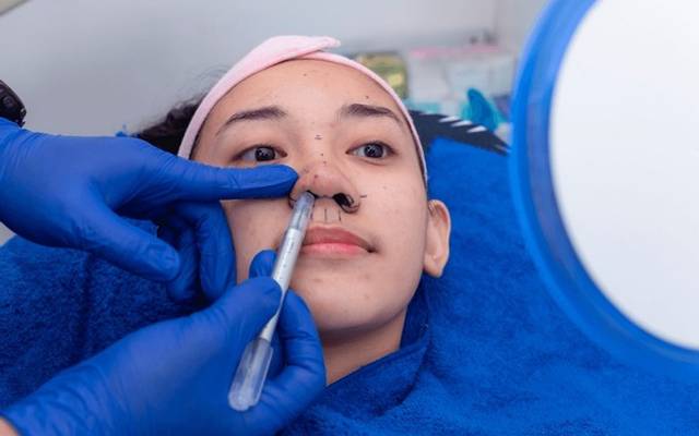 What Happens During an Alarplasty Procedure