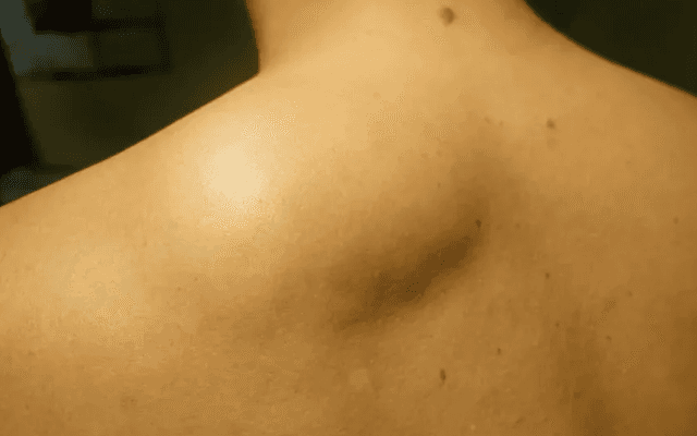 Why Does Lipoma Treatment Cost Vary So Much