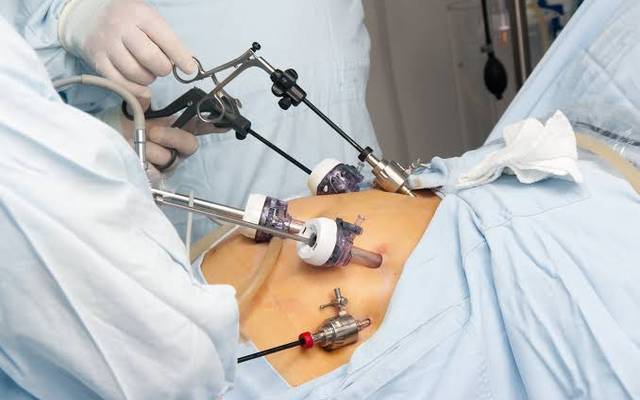 How Is Gallbladder Stones Surgery Performed Today?