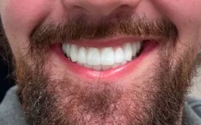 How a Trusted Implant Dentist in Lexington Kentucky Can Restore Your Smile