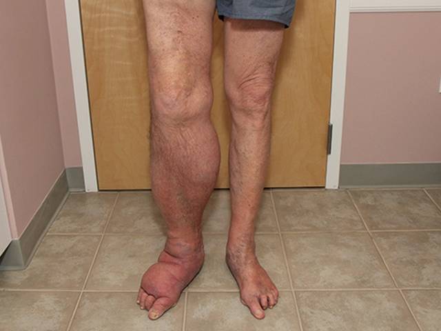 Health of Lymph Savior: Benefits, Side Effects & User Reviews