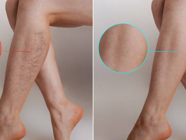 health of Veincare Varicose Vein Root Remover Reviews: Benefits & Where to Buy? (2025 Shocking Results)