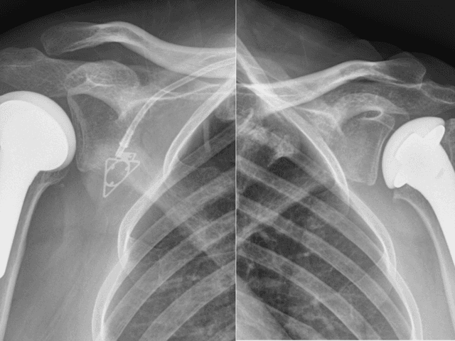 Business of India Shoulder Arthroplasty Market Share, Trends and Forecast 2025-2033