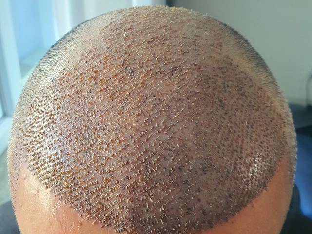 health of Can Hair Transplant Improve Areas With Reduced Hair Density?
