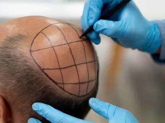 health of How Does Crown Hair Transplant Recreate Natural Crown Density?