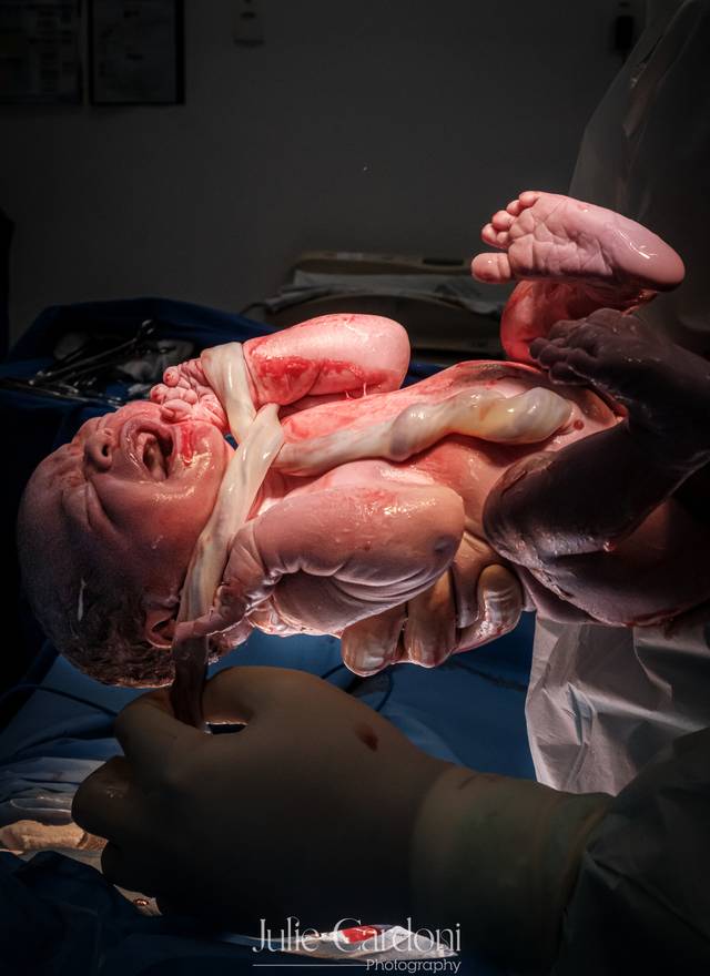 Fotografia de Nascimento de Nascimento do Enrico - Parto Cesárea