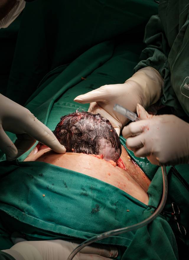 Fotografia de Nascimento de Nascimento do Lucas | Parto Cesárea