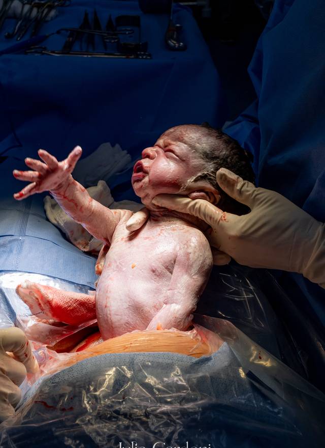 Fotografia de Nascimento de Nascimento Ravi e Romeo | Parto Cesáreo