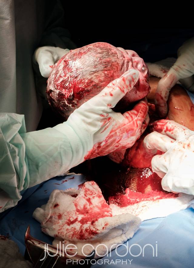 Fotografia de Nascimento de Parto Cesária - Nascimento do Rafael