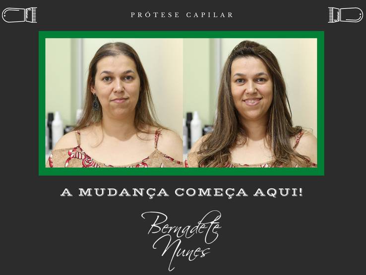 Vídeos de Prótese Capilar