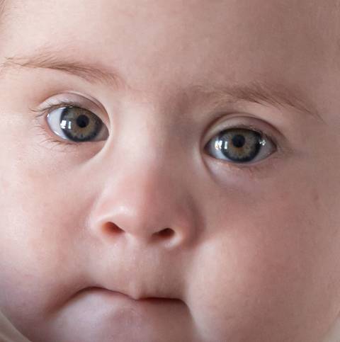 rosto de criança com síndrome de down'