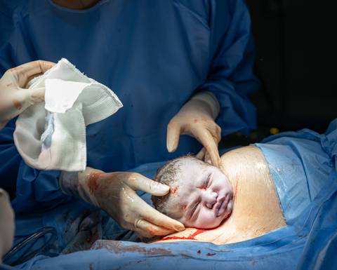 nascimento de um bebê em um parto cesariano'