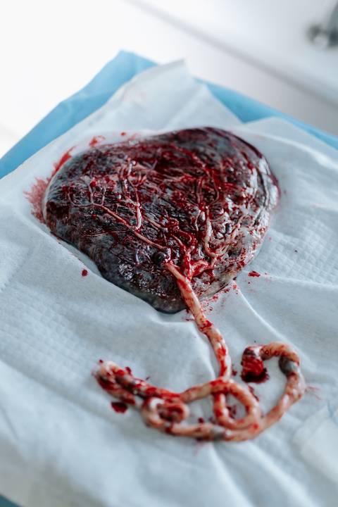 Foto em detalhe da placenta e do cordão umbilical sobre campo estéril.'