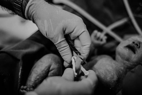 corte de cordão umbilical'