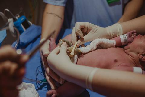 clampeamento de cordão umbilical do bebê após nascimento'