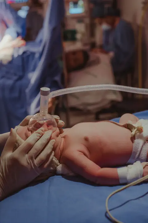 bebê com máscara de oxigênio em perspectiva à mãe na maca cirúrgica após cesárea'