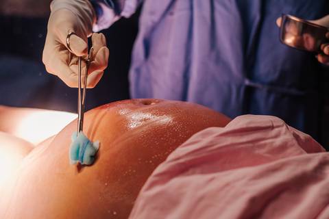 Aplicação da anestesia para parto cesariana no Hospital Tacchini, fotografia de parto em Bento Gonçalves RS.'