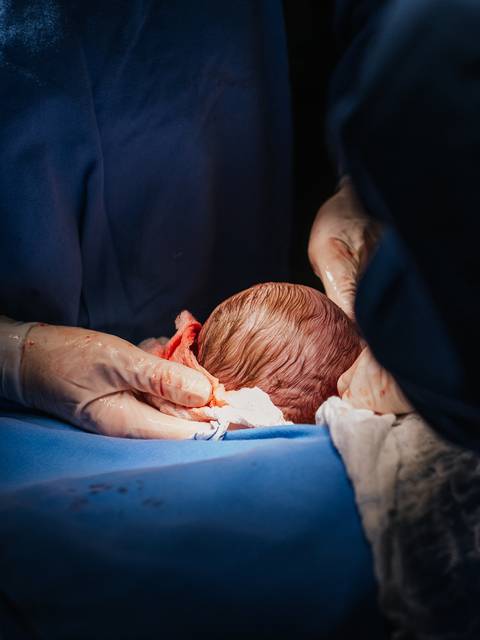 Nascimento do bebê durante cesariana no Hospital Tacchini, fotografia do momento do parto em Bento Gonçalves.'