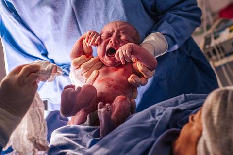Momento do nascimento da bebê durante parto cesariana no Hospital Tacchini, fotografia de parto profissional.'