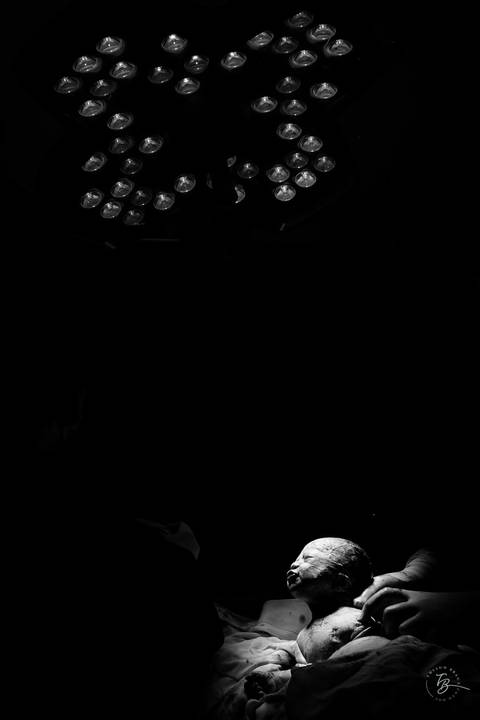 Fotografia de parto na maternidade Ilha em Florianópolis, cesárea, registros por Thiago Braga fotografia'