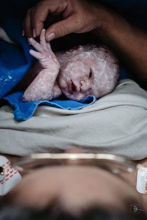 Fotografia de parto na maternidade Ilha em Florianópolis, cesárea, registros por Thiago Braga fotografia'