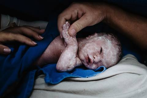 Fotografia de parto na maternidade Ilha em Florianópolis, cesárea, registros por Thiago Braga fotografia'