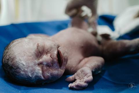 Fotografia de parto na maternidade Ilha em Florianópolis, cesárea, registros por Thiago Braga fotografia'