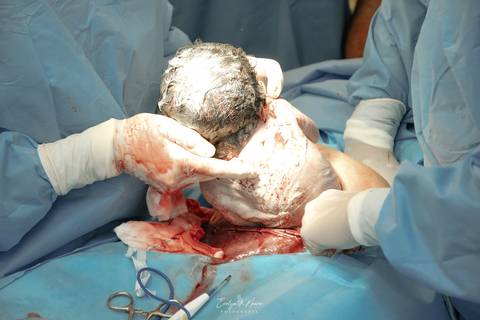 Fotografia de Parto - Newborn - Evelyn Moura Fotografia em Niterói, Rio de Janeiro - ensaio infantil - newborn de recém nascido - partos - parto em niteroi - registro de parto - maternidade são francisco - doce nascer - parto humanizado'