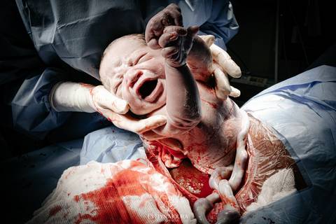 Fotografia de Parto - Newborn - Evelyn Moura Fotografia em Niterói, Rio de Janeiro - ensaio infantil - newborn de recém nascido - partos - parto em niteroi - registro de parto - maternidade são francisco - doce nascer - parto humanizado - andrea barbosa '