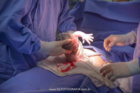 fotografia-de-nascimentos-parto-porto-velho-pvh-ro-hospital-9-de-julho-fotografa-greyce-lene-2019 cesariana'