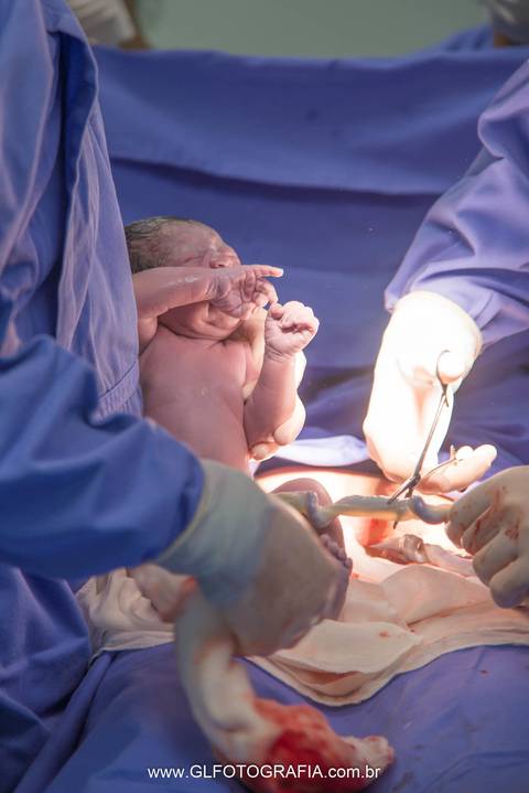 fotografia-de-nascimentos-parto-porto-velho-pvh-ro-hospital-9-de-julho-fotografa-greyce-lene-2019 cesariana cortando o cordão umbilical'