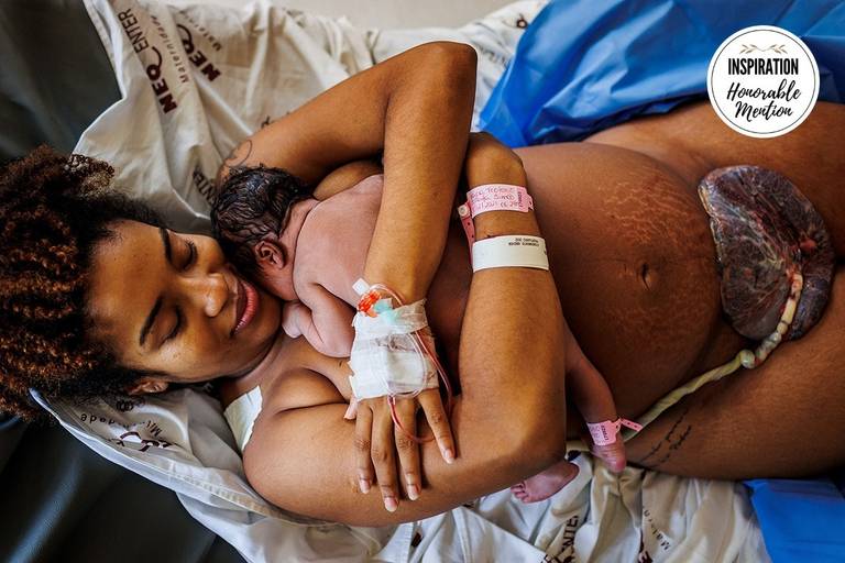 Adriana Costa foi premiada pela Inspiration Family Awards pela foto de uma mãe abraçando sua filha emocionada com ela ainda ligada a placenta