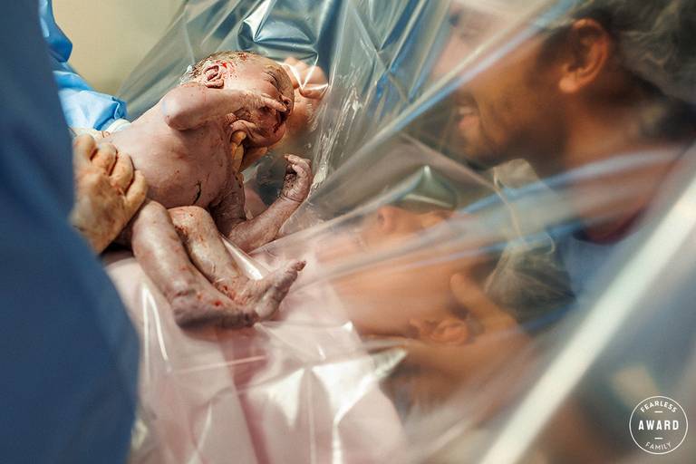 foto de Adriana Costa da emoção dos pais vendo a filha logo após nascer por uma cesárea foi premiada pela Fearless Family Photographers