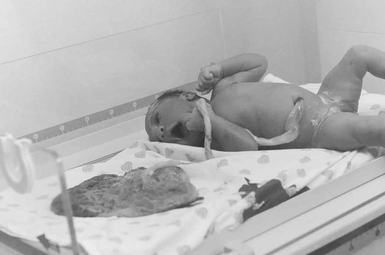 Bebê ao lado da sua placenta durante Um Parto Humanizado na Perinatal da Barra da Tijuca no Rio de Janeiro
